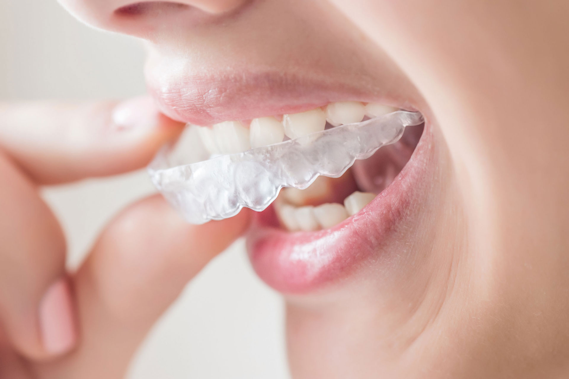 The invisalign orthodontics Differences between the Lite and the Full? - Clnica Blasi