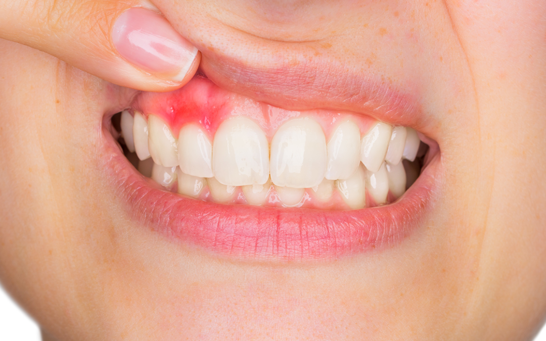 Cómo saber si tengo gingivitis y periodontitis? - Clínica Blasi