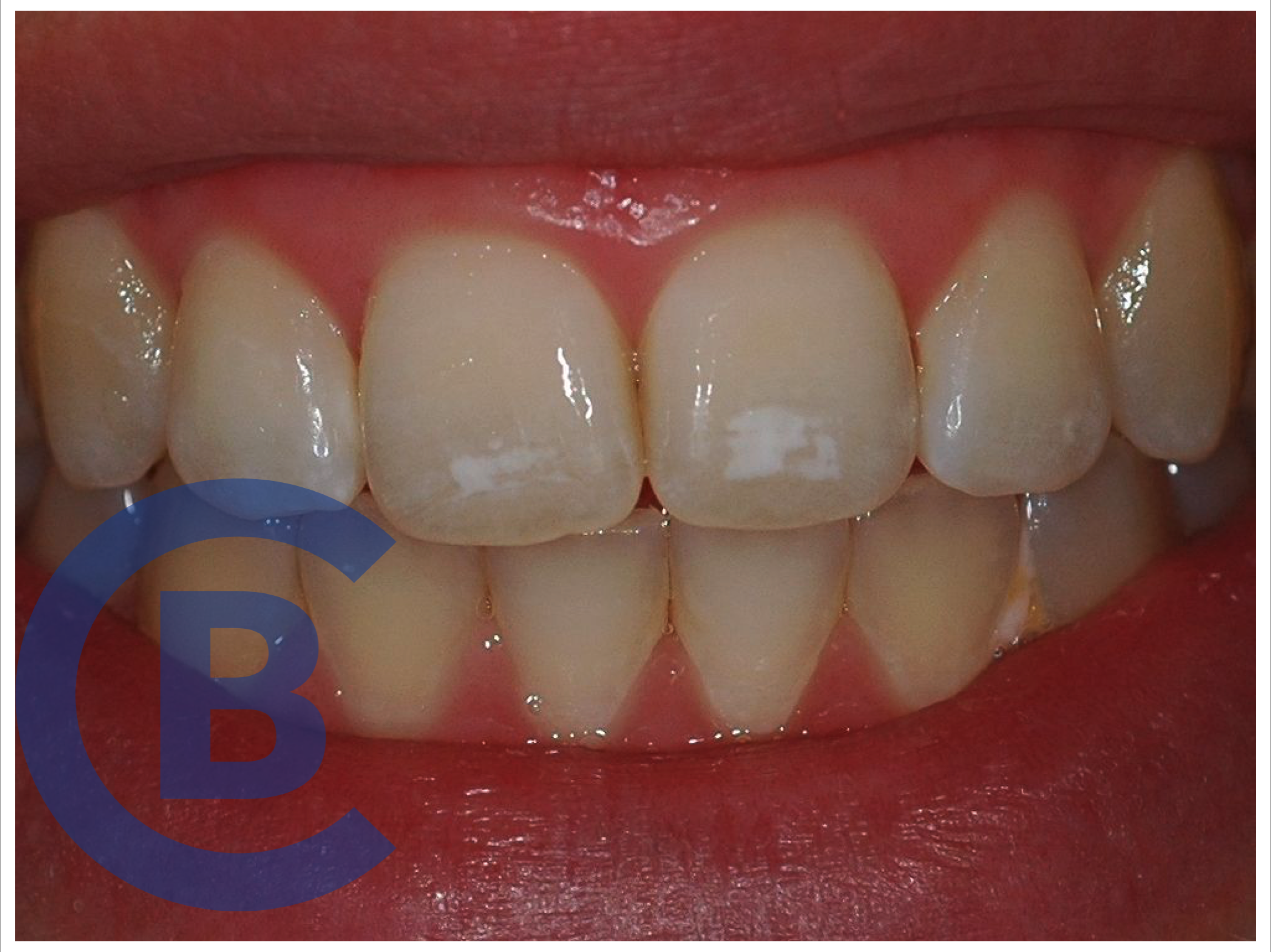 ¿Sabes qué son las manchas blancas que aparecen en los dientes?