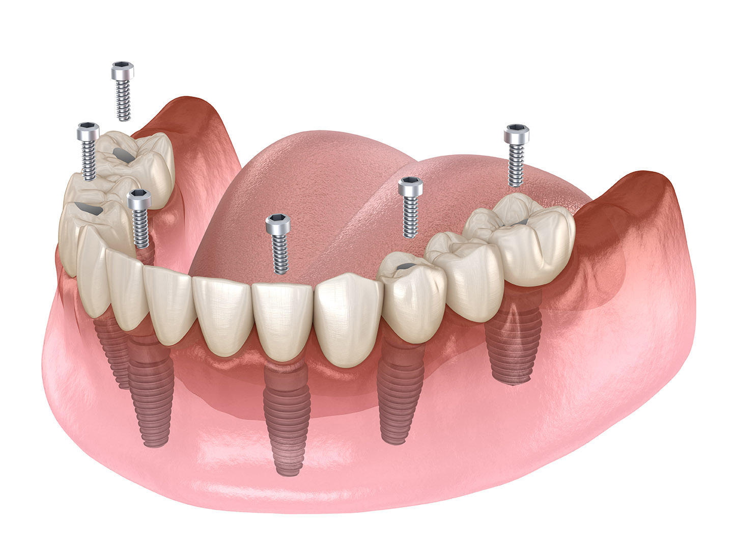 placing dental implants