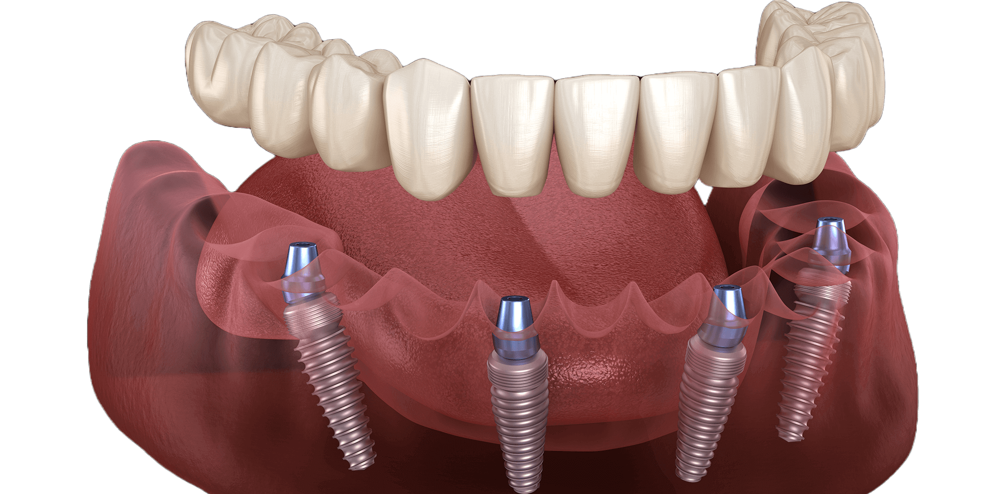 rechazo de los implantes dentales