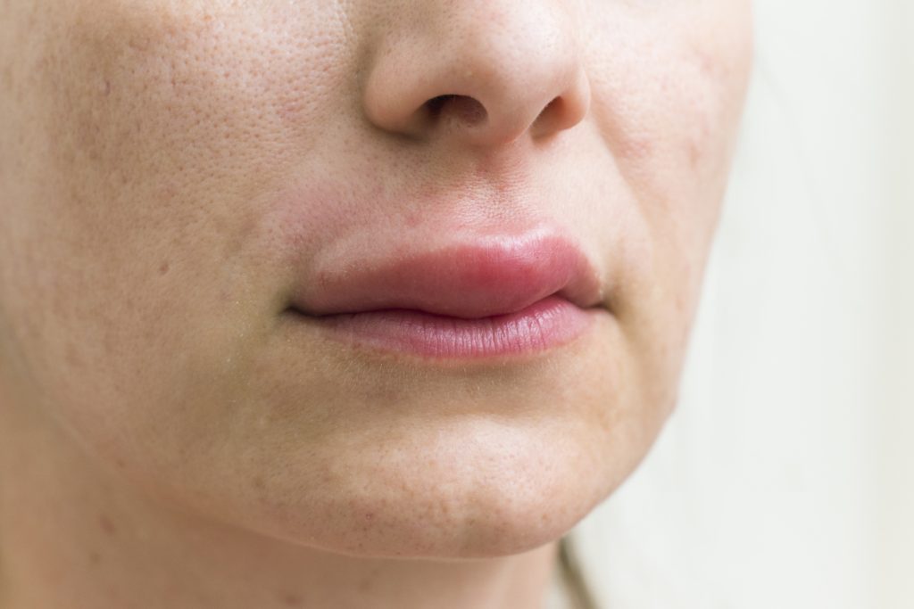 labios hinchados