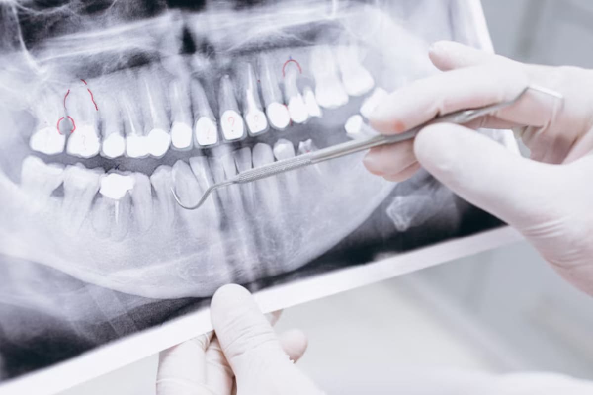 Implantes con poco hueso: elevación de seno y alternativas