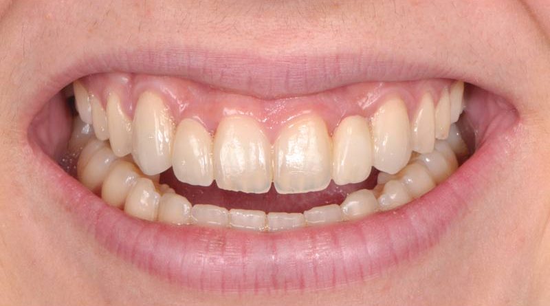 Paciente-5-Despues-1