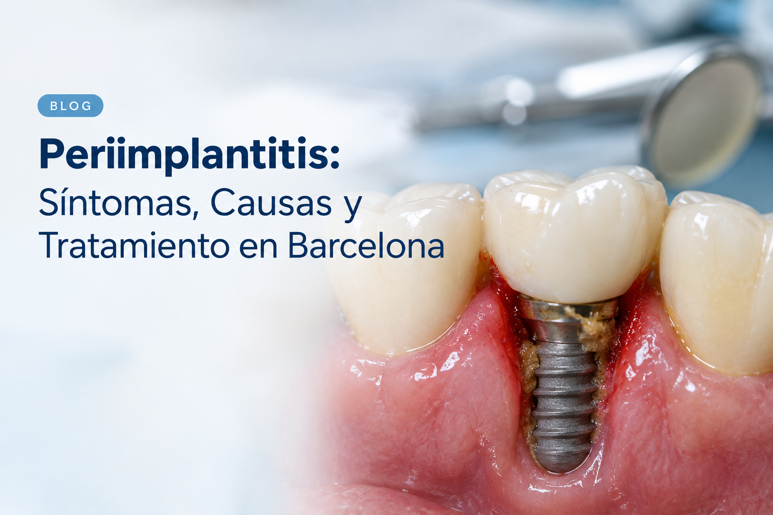 ¿Qué es la Periimplantitis? Causas, Prevención y Tratamiento para Salvar tus Implantes